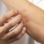 Sivrisinek vs Midge: Hangisi Seni Isırıyor? (Ve Her İkisi Nasıl Durdurulur)